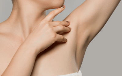 Hiperhidrosis axilar: cómo controlar el exceso de sudor con neuromoduladores
