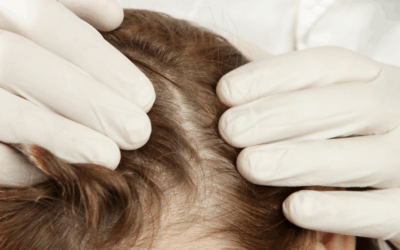 Tipos de alopecia y tratamientos: ¿cuál es el más adecuado para cada caso?